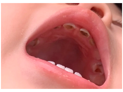 河北惟德口腔涂氟流程簡單，孩子配合度拉滿