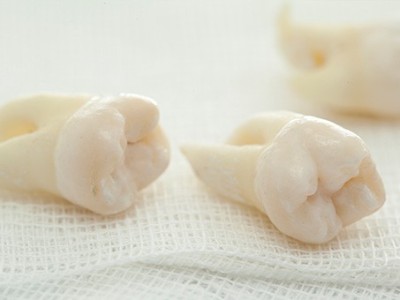 智齒疼了，這牙非拔不可嗎？