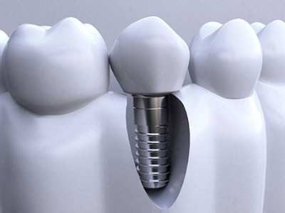 承德種植牙價格表，2024種植牙多少錢一顆呢?