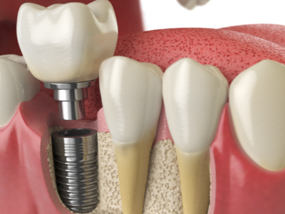 選擇種植牙后要做哪些日常維護(hù)？