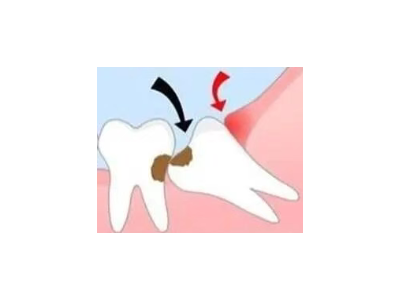 吃完飯后老塞牙？別大意！這可能是你的牙齒在報(bào)警
