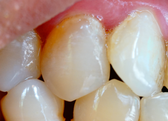 牙齒表面的牙釉質(zhì)掉了還可以修復(fù)嗎？