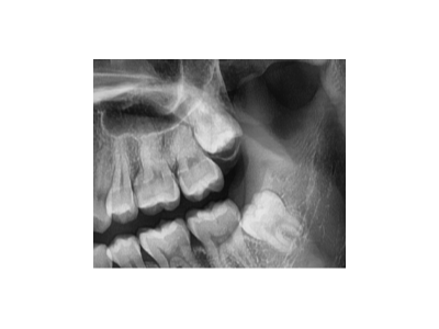 既然「智齒」不宜久留，為什么不能一次性拔掉？