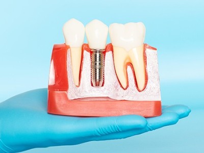 種牙VS鑲牙，你適合哪種?