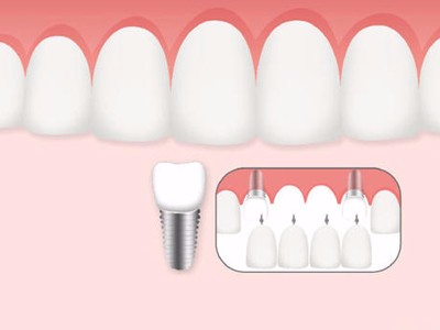 惟德口腔口腔種植怎么樣？惟德口腔就來為您一一解答