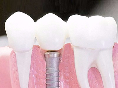 在承德口腔種植齒需要多少錢？惟德口腔一一為您道來(lái)